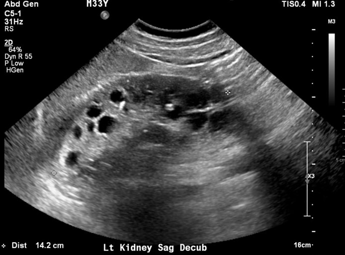 A 33-year-old man comes to the office due to left flank pain.  He has no chronic medical conditions and takes no medications.  The patient does not use tobacco, alcohol, or illicit drugs.  Ultrasonogram of the left kidney is shown below.  The right kidney has similar findings.   Compared to the general population, this patient's condition most increases the likelihood of which of the following complications? A) Intracranial bleeding B) Pancreatic cancer C) Pulmonary embolism D) Restrictive cardiomyopathy E) Severe hypercalcemia