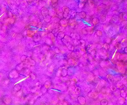 A 52-year-old man comes to the emergency department with pain and swelling of his right knee for the last 24 hours.  He has not traveled recently and has no recent history of injury or gastrointestinal or genitourinary infection.  The patient was diagnosed with pulmonary sarcoidosis 5 years ago when he developed hilar lymphadenopathy and interstitial lung disease.  His sarcoidosis responded to treatment with glucocorticoids and went into remission.  He has been disease-free for the past 4 years.  The patient also has a 10-year history of type 2 diabetes mellitus, hypercholesterolemia, and hypertension.  Blood pressure is 140/86 mm Hg and pulse is 90/min.  BMI is 34 kg/m<sup>2</sup>.  Physical examination is notable for a moderate-size effusion of the right knee with surrounding erythema and warmth.  The knee joint is aspirated.  Microscopic examination of the fluid is shown in the image below.   Which of the following is the most likely etiology of this patient's joint effusion? A) Immunocomplex deposition B) Infection of the joint by fungal organisms C) Infection of the joint by Staphylococcus aureus D) Inflammatory reaction to calcium pyrophosphate crystals E) Inflammatory reaction to monosodium urate crystals