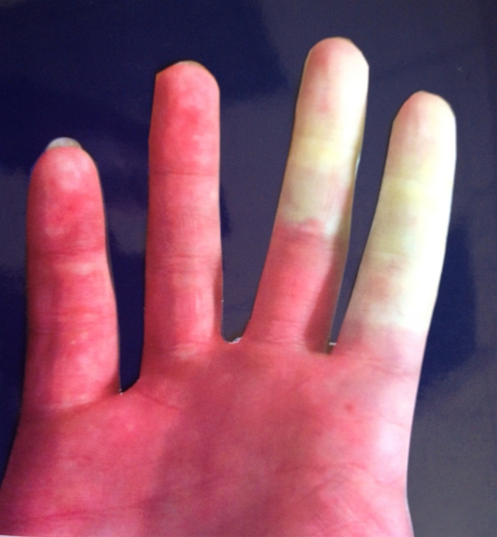 A 28-year-old woman comes to the clinician with pain and numbness of both hands over the last 6 months.  Cold temperatures seem to precipitate these episodes.  Medical history includes exercise-induced asthma, lower back pain, and hypothyroidism.  The patient takes levothyroxine daily.  She does not use alcohol or illicit drugs but has a 10-pack-year smoking history.  Laboratory studies show normal complete blood count and chemistry panel.  TSH is 4.7 µU/mL.  Antinuclear antibody screen is negative.  Physical examination findings are shown in the image below.   In addition to smoking cessation, which of the following is the best initial therapy for this patient? A) Amlodipine B) Clonidine C) Increase in levothyroxine dose D) Lisinopril E) Metoprolol