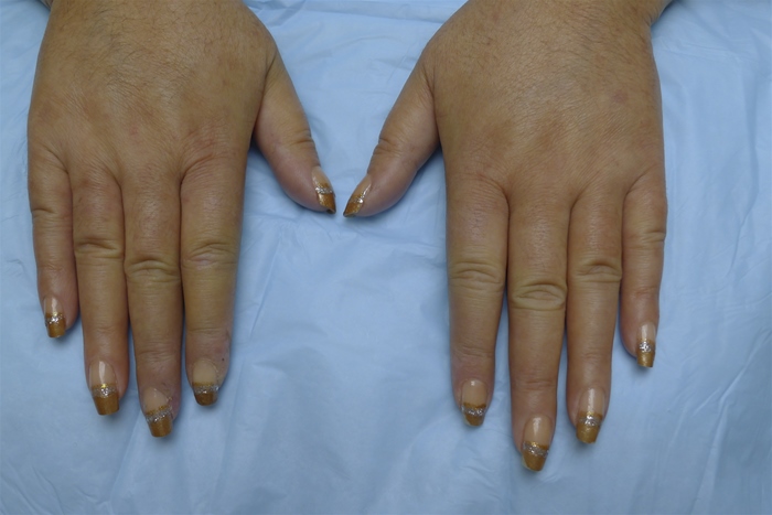 A 49-year-old woman comes to the office due to swelling and stiffness of the hands for the past several months.  For the last year, she has also had intermittent episodes of pain and bluish discoloration of the fingers, especially when exposed to cold.  The patient is unable to play tennis on weekends like she did before due to fatigue and breathlessness.  She takes pantoprazole for heartburn and lisinopril for hypertension.  The patient drinks alcohol on social occasions but does not smoke cigarettes.  Temperature is 37.1 C (98.8 F) , blood pressure is 140/90 mm Hg, and pulse is 78/min.  Physical examination shows puffiness of the hands and skin thickening in the fingers, as shown in the image below.   Lung auscultation reveals bibasilar fine inspiratory crackles.  Which of the following tests is most likely to be positive in this patient? A) Anticardiolipin antibodies B) Anti-cyclic citrullinated peptide antibodies C) Antimitochondrial antibodies D) Anti-neutrophil cytoplasmic antibodies E) Anti-smooth muscle antibodies F) Anti-topoisomerase I antibodies
