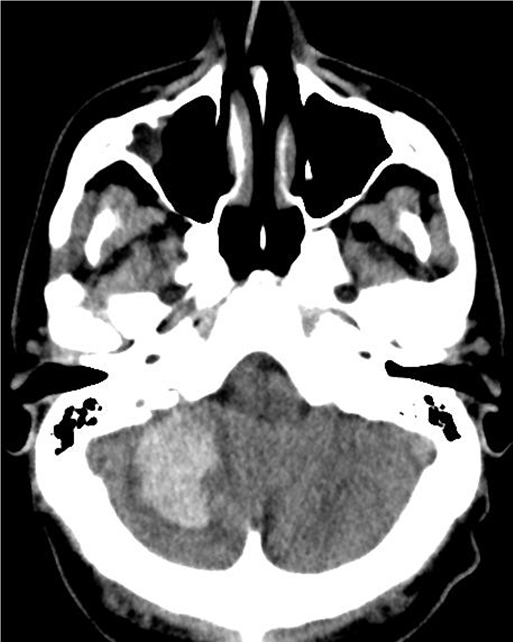 A 69-year-old man comes to the emergency department due to severe occipital headache, nausea, and vomiting for the last 3 hours.  He has never had a headache like this before and has otherwise been in good physical condition.  The patient was told several years ago that he has high blood pressure, but he has not been taking any medications or seen any health care providers.  He has smoked half a pack of cigarettes daily for 40 years and drinks 1 or 2 cans of beer every evening.  Both of his parents died of natural causes.  Blood pressure is 160/90 mm Hg and pulse is 86/min and regular.  His noncontrast head CT scan is shown in the image below.   Which of the following physical examination findings is most likely to be seen in this patient? A) Homonymous hemianopia B) Left hemineglect C) Left hemiplegia D) Left hemisensory loss E) Pinpoint pupils F) Right eye vision loss G) Right hemiataxia H) Right hemiplegia I) Right hemisensory loss