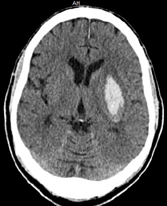 A 56-year-old man comes to the emergency department an hour after acute onset of right-sided weakness and numbness.  His symptoms progressed over a course of several minutes, and he is now experiencing nausea and headache.  The patient has not seen a physician for many years and takes no medications.  He has smoked a half pack of cigarettes per day for 32 years.  Blood pressure is 170/90 mm Hg and pulse is 88/min.  Physical examination shows 3/5 muscle strength and hyperreflexia in the right upper and lower extremities.  Sensation to pinprick and light touch is decreased on the right side.  He has mild dysarthria.  ECG shows normal sinus rhythm and left ventricular hypertrophy.  Fingerstick blood glucose is 130 mg/dL and serum LDL is 142 mg/dL.  Noncontrast head CT scan is shown below.   Which of the following is the most likely cause of this patient's symptoms? A) Amyloid vasculopathy B) Arteriovenous malformation C) Berry aneurysm D) Carotid artery atherosclerosis E) Cerebral venous thrombosis F) Hypertensive vasculopathy G) Injury of the middle meningeal artery H) Metastatic carcinoma I) Tearing of the bridging veins