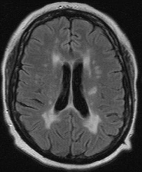 A 35-year-old woman comes to the office due to a 2-day history of weakness in her right hand.  She has no other symptoms but reports a transient episode of lower extremity numbness that resolved spontaneously.  The patient has a history of herpes labialis and she takes valacyclovir as needed.  She recently began taking a vitamin D supplement after she was found to have low serum vitamin D levels.  Other medications include oral contraceptive pills; she has also received annual influenza vaccines.  The patient does not use tobacco, alcohol, or illicit drugs.  Family history is significant for type 2 diabetes mellitus in her mother and hypertension in her father.  BMI is 28 kg/m<sup>2</sup>.  Examination shows mild spasticity in her right hand.  MRI of the brain shows the findings seen below.   Which of the following is most strongly associated with this patient's current condition? A) Annual influenza vaccination B) Failure to use barrier contraception C) Recurrent herpes simplex infection D) Valacyclovir use E) Vitamin D deficiency