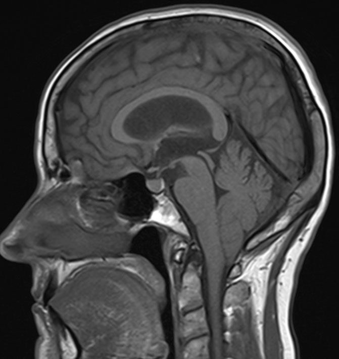 An 18-year-old man is evaluated due to worsening headaches.  For the last several months, the patient has had intermittent, dull, occipital headaches, which are often brought on by physical activity, cough, or straining.  The pain is usually accompanied by nausea and dizziness, and the symptoms spontaneously resolve after several minutes.  There is no history of fever, chills, photophobia, vision disturbances, or focal weakness or numbness.  He has no prior medical conditions and takes no medications.  Vital signs are normal.  Physical examination, including neurologic examination, shows no abnormalities.  MRI of the head is shown in the image below:   This patient is at greatest risk for which of the following in association with his current condition? A) Cardiac rhabdomyoma B) Optic neuritis C) Parathyroid adenoma D) Syringomyelia E) Vestibular schwannoma
