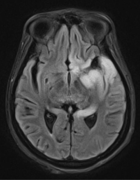 <strong>An 18-year-old man is brought to the emergency department following a generalized tonic-clonic seizure.  He developed full body jerking at home this morning, which lasted approximately 1 minute.  The episode occurred just before the patient was about to visit the clinic for evaluation of a worsening headache for the past 2 days.  His parents say that he has also seemed clumsy over the same period, including tripping a few times yesterday.  He has no history of seizures and was previously healthy except for seasonal allergies managed with over-the-counter medications.  Temperature is 38.9 C (102 F), blood pressure is 130/80 mm Hg, and pulse is 92/min.  The patient is awake but oriented only to person.  Pupillary examination is unremarkable.  The patient has bilateral hyperreflexia in the upper and lower extremities.  MRI of the brain is shown below:   Which of the following is the most likely diagnosis for this patient?</strong> A)Drug-induced encephalopathy B)Herpes simplex virus encephalitis C)Medulloblastoma D)Reye syndrome E)Subacute sclerosing panencephalitis <div style=padding-top: 35px> 