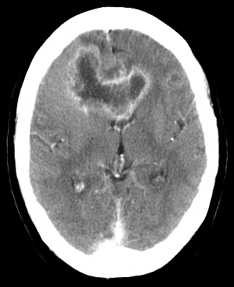 <strong>A 45-year-old white male presents with a 4-month history of headaches.  The headache is generalized, dull, constant, and worsened by bending, coughing and sneezing.  It is unresponsive to simple analgesics, and associated with nausea and vomiting.  His wife says he has been acting strangely for the last few months, and she has noted a personality change.  The neurological examination is non-focal.  Fundoscopy reveals papilledema.  His CT scan is shown below.   Which of the following is the most likely diagnosis?</strong> A)Brain abscess B)Metastatic brain tumor C)Glioblastoma multiforme D)Low-grade astrocytoma E)Cerebral infarction <div style=padding-top: 35px> 