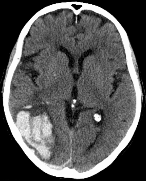 <strong>An 86-year-old woman is brought to the emergency department due to progressive confusion and lethargy for the past several hours.  The patient has a history of Alzheimer dementia, and her family reports that she has been gradually declining in mental and physical capacity for the last 6 months.  She also has had several falls and requires assistance with daily activities.  Other medical conditions include hypertension and osteoarthritis.  Temperature is 38 C (100.4 F), blood pressure is 170/100 mm Hg, and pulse is 70/min.  On physical examination, the patient is somnolent but arousable.  She withdraws from painful stimuli applied to her right side but not to her left.  Noncontrast CT scan of the head is shown in the image below:   Which of the following is the most likely underlying cause of this patient's current condition?</strong> A)Amyloid angiopathy B)Arteriovenous malformation rupture C)Bridging vein tear D)Meningeal artery tear E)Saccular aneurysm rupture <div style=padding-top: 35px> 