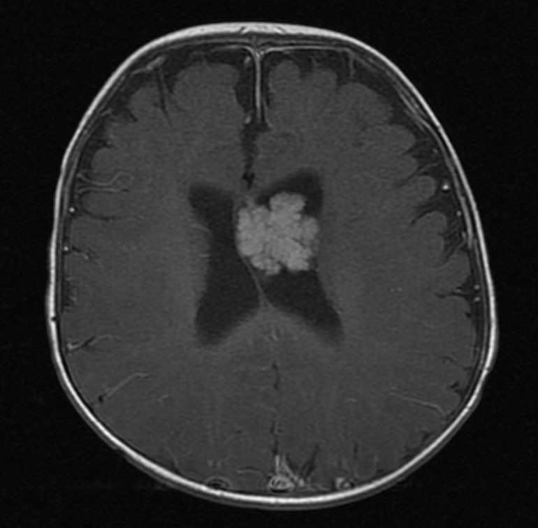 A 6-month-old boy is brought to the clinic for routine care.  He cannot sit with support, and his mother is concerned that his head is large for his age.  For the last week, the patient has napped more frequently and vomited at the end of sleep.  Height and weight are at the 25th percentile.  Head circumference is at the 95th percentile (increased from the 50th percentile at birth and the 75th percentile at age 4 months) .  The anterior fontanelle is bulging.  MRI of the head is shown in the image below:   Which of the following is the most likely cause of this patient's condition? A) Congenital atresia of the ventricular foramina B) Decreased cerebrospinal fluid absorption C) Generalized cerebral edema D) Increased cerebrospinal fluid production E) Intraparenchymal hemorrhage