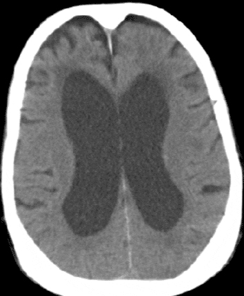 A 79-year-old woman is brought to the office due to recurrent falls.  Over the past year, the patient has become increasingly unsteady while walking and has had several falls.  The patient has had no headaches, vision changes, nausea, or vomiting.  Medical history is significant for hypertension, for which she takes losartan.  Vital signs are within normal limits.  Cardiopulmonary and abdominal examinations are unremarkable.  Neurological examination shows normal cranial nerves and fundoscopy.  There is increased tone and hyperreflexia of the lower extremities.  Sensation to light touch and vibration is intact.  When instructed to walk, the patient moves slowly with small steps and a wide base; she takes several steps to turn around.  CT scan of the brain is shown below.   This patient's symptoms would most likely improve with which of the following? A) Acetazolamide B) Cholinesterase inhibitors C) High-dose prednisone D) High-volume lumbar puncture E) Levodopa and carbidopa