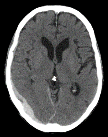 An 80-year-old woman is brought to the emergency department due to progressive confusion, generalized weakness, and unsteadiness for the past several days.  The patient had a right femoral fracture 4 months ago and underwent hip surgery.  She has been using a walker to ambulate since coming home from a physical rehabilitation facility 3 weeks ago.  She has had no fever, chest pain, vomiting, diarrhea, or dysuria.  The patient's medical problems include hypertension, hyperlipidemia, coronary artery disease, transient ischemic attack, and persistent atrial fibrillation.  Her medications include aspirin, warfarin, metoprolol, and a statin.  Temperature is 37.2 C (99 F) , blood pressure is 140/90 mm Hg, pulse is 72/min and irregular, and respirations are 14/min.  CT scan of the head without contrast is shown below.   Which of the following is the most likely cause of this patient's condition? A) Dislodged cardiac thrombus B) Hyalinosis of the small vessels C) Impairment of cerebrospinal fluid absorption D) Injury of the middle meningeal artery E) Rupture of an aneurysm F) Shearing of the white matter tracts G) Tearing of the bridging veins H) Thrombosis of the posterior cerebral artery I) Tumor of the arachnoid cells