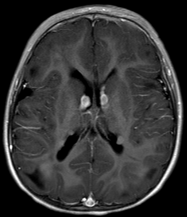 A 3-year-old boy is brought to the clinic due to increased seizure frequency.  Over the past year, the patient has had recurrent tonic-clonic seizures that are poorly controlled despite multiple antiepileptic medications.  The seizures have become more frequent in the past month and now occur daily.  The patient has developmental delay and receives speech and physical therapy.  He was born at term without perinatal complications and has received all age-appropriate vaccinations.  Family history includes mild intellectual disability in his father.  Physical examination is notable for multiple 1- to 2-cm hypopigmented macules on the trunk and lower extremities.  MRI of the brain reveals subependymal nodules, as shown in the image below:   Which of the following is associated with the most likely underlying condition in this patient? A) Cardiac rhabdomyoma B) Optic nerve glioma C) Pheochromocytoma D) Vestibular schwannoma E) Wilms tumor (nephroblastoma) 