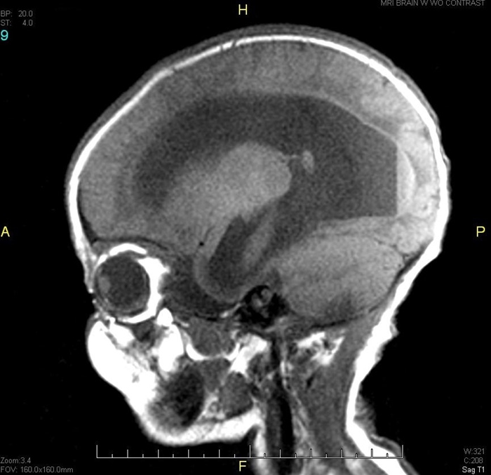 A 1-month-old boy is brought to the emergency department by his mother due to fussiness and vomiting.  Three days ago, the patient vomited after being laid down for a nap.  The vomitus was not bloody or bilious.  The mother thought the vomiting was due to gastroesophageal reflux and kept the infant upright after his next feedings.  However, he continued to vomit several times a day and today has been difficult to console.  Urine output remains normal.  The patient was born at home via spontaneous vaginal delivery and is exclusively breastfed.  He has received no vaccinations or medications.  Temperature is 37.4 C (99.3 F) .  Vital sign measurement also reveals intermittent bradycardia and hypertension.  The anterior fontanelle is bulging.  Eye examination shows a persistent downward gaze bilaterally.  Cardiac examination reveals no murmurs.  Extremities appear normal.  Head imaging is as shown:   Which of the following is the most likely cause of this patient's presentation? A) Chiari II malformation B) Glioblastoma C) Meningitis D) Trisomy 13 E) Vitamin K deficiency