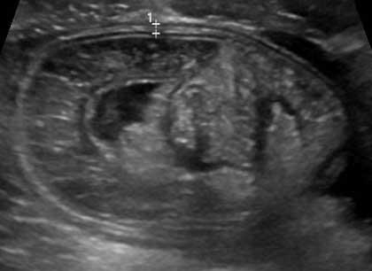 A 3-year-old boy is brought to the emergency department due to abdominal pain.  The pain began several hours ago and comes and goes.  During these episodes, he holds his belly, screams, and draws up his legs.  He has had nonbloody, nonbilious vomiting 3 times since the last painful episode.  Between the episodes, the patient has no pain and is playful.  His last bowel movement was yesterday and was normal.  Two weeks ago, he had gastroenteritis that resolved after 3 days.  He otherwise has no chronic medical conditions and takes no medications.  Temperature is 37.2 C (99 F) , blood pressure is 95/50 mm Hg, and pulse is 100/min.  Abdominal examination shows a soft abdomen that is tender with voluntary guarding to palpation at the right upper and lower quadrants.  Rectal examination reveals no fissures or hemorrhoids.  The remainder of the examination is normal.  Ultrasound of the abdomen is shown in the image below:   Which of the following is the best next step in management of this patient? A) Air enema B) CT scan of the abdomen C) Exploratory laparotomy D) HIDA scan E) Technetium-99m pertechnetate scan