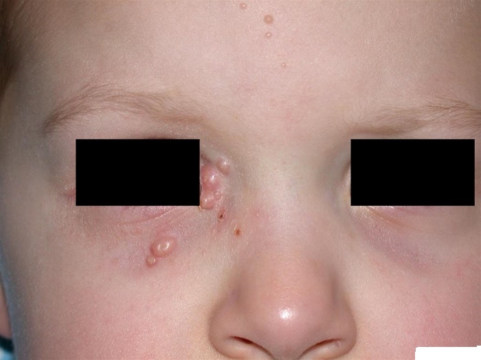 A 5-year-old boy is brought to the office for evaluation of multiple new growths on the face, as shown in the image below:   The patient can open and close his eyes without pain or difficulty.  Examination shows no other abnormalities.  What is the most appropriate next step in management? A) Biopsy the lesion B) Inform child protective services C) Inject intralesional steroid D) Observe and provide reassurance E) Perform genetic testing for NF1 mutation