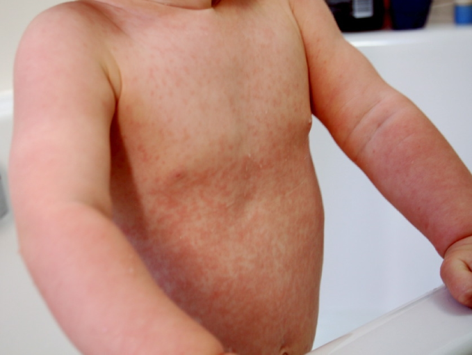 A 10-month-old girl is brought to the office due to a rash.  The patient has had a low-grade fever for the past 3 days that has been controlled with acetaminophen.  A rash developed on her face 2 days ago and has since spread to her chest, abdomen, and extremities.  The patient has had no cough, rhinorrhea, nasal congestion, vomiting, or diarrhea.  She has otherwise been healthy.  The patient has received all routine, age-appropriate vaccinations and takes no medications.  Temperature is 38 C (100.4 F) , blood pressure is 100/50 mm Hg, pulse is 88/min, and respirations are 18/min.  Physical examination shows a playful infant with small, tender lymph nodes in the suboccipital, posterior auricular, and posterior cervical areas.  There is patchy erythema on the soft palate.  The rash is shown in the image below.  A similar-appearing rash is present on the face.     The remainder of the examination is normal.  Which of the following diagnoses is most consistent with this patient's presentation? A) Erythema infectiosum B) Kawasaki disease C) Measles D) Rubella E) Scarlet fever