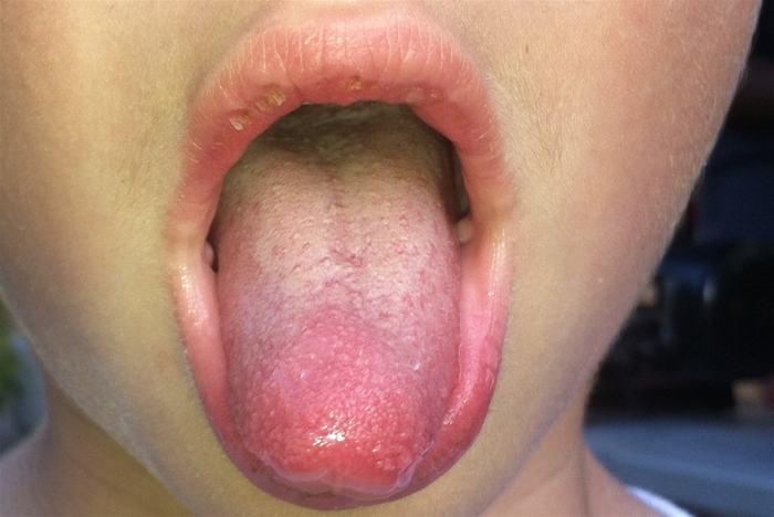 A 4-year-old girl is brought to the emergency department due to a 1-week history of fever.  Her family has also noticed that the patient is  much crankier than normal  and has decreased oral intake.  She has had no cough, rhinorrhea, or emesis.  She has no medical conditions, takes no daily medications, and has not received age-appropriate vaccines.  Temperature is 39.4 C (102.9 F) , blood pressure is 90/60 mm Hg, and pulse is 135/min.  On physical examination, the patient is irritable and has mild facial flushing.  Bilateral conjunctivae are injected.  A 1.7-cm, tender, mobile anterior cervical lymph node is palpated.  Cardiac examination demonstrates a regular rhythm and no murmurs, rubs, or gallops.  The trunk and extremities have a blanching maculopapular eruption; the hands and feet are erythematous and edematous.  An image of the patient's mouth is shown below.   The posterior pharynx is mildly injected without exudates or tonsillar hypertrophy.  Which of the following is the best next step in management of this patient? A) Echocardiogram B) Oral penicillin therapy C) Parvovirus serology D) Reassurance and close follow-up E) Serum measles IgM antibody