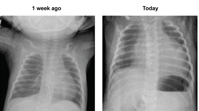 A 4-week-old male infant with hypoplastic left heart syndrome has had difficulty feeding and an episode of vomiting over the last 24 hours.  He was born at term via normal spontaneous vaginal delivery.  The patient underwent palliative heart surgery at age 1 week; the procedure involved cardiotomy and extensive intracardiac and aortic arch repair.  His postoperative course was uncomplicated, and he has remained in the hospital for weaning of oxygen and titration of cardiac medications.  Two additional palliative surgeries are planned.  Temperature is 38.3 C (101 F) , blood pressure is 80/40 mm Hg, pulse is 175/min, and respirations are 70/min.  Pulse oximetry is 80% on room air.  He is cyanotic and small for his age.  Cardiopulmonary examination is notable for distant heart sounds, tachycardia, and tachypnea.  Abdominal examination is normal.  Chest radiographs from a week ago and today are shown below.   Which of the following is the most likely cause of this patient's acute presentation? A) Congestive heart failure B) Endocarditis C) Mediastinitis D) Pericardial effusion E) Pulmonary embolism