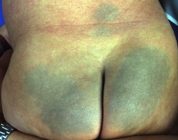 A 4-month-old boy is brought to the office by his mother for a routine examination.  This is the patient's first visit as the mother recently moved to the area.  Review of medical records shows that the only parental concerns at age 2 months were excessive gassiness and spitting up, both of which have resolved.  The patient was born full term and has no chronic medical conditions.  Vaccinations are up to date.  His parents recently divorced, and he now lives with his mother and 9-year-old sister.  The sister has attention-deficit hyperactivity disorder and anxiety.  The patient's height and weight are at the 50th and 75th percentiles, respectively.  On physical examination, he is smiling and reaching for the examiner's stethoscope.  He holds his bottle for a few seconds and then drops it on the ground.  The patient can sit with support and roll from front to back.  Flat, nonblanching, nontender patches over his sacrum and buttocks are shown in the image below.   Which of the following is the most appropriate next step in management of this patient? A) Complete blood count and coagulation studies B) MRI of the brain C) Reassurance D) Sacral ultrasound E) Skeletal survey