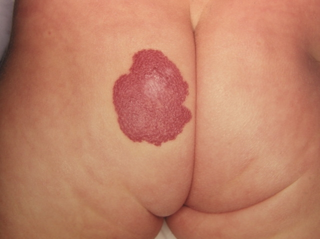 A 5-month-old girl is brought to the office by her parents for evaluation of a skin lesion on her buttock.  Her parents initially noticed a small, red macule several weeks after her birth and thought it was an insect bite.  They have been applying over-the-counter hydrocortisone cream but the lesion has progressively enlarged, especially over the last 2 months.  The skin lesion is shown in the image below.   Which of the following is the most likely diagnosis in this patient? A) Arteriovenous malformation B) Cherry angioma C) Nevus flammeus D) Nevus simplex E) Pyogenic granuloma F) Superficial hemangioma