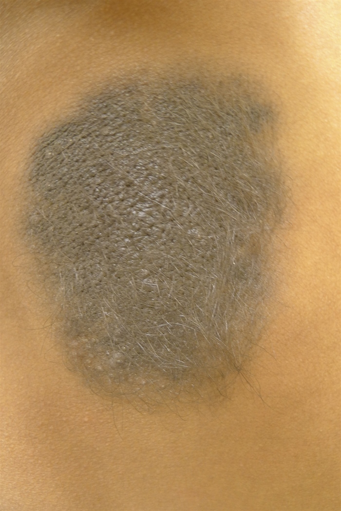 A 4-week-old boy is brought to the office for his first well-child visit.  The patient was born at 38 weeks gestation to a 27-year-old woman following an uncomplicated pregnancy and delivery.  He has been exclusively breast-fed since birth and has had normal urine and stool output.  The patient takes supplemental vitamin D and no other medications.  His 4-year-old brother has neurofibromatosis but is otherwise healthy.  The patient is well-appearing and vigorous.  His weight and length are at the 50th percentile.  There is a 5-cm skin lesion with overlying hair on the upper back, as shown below.  The remainder of the skin examination is unremarkable.  Which of the following is the most likely diagnosis for this patient?   A) Café au lait macule B) Congenital dermal melanocytosis C) Congenital melanocytic nevus D) Nevus flammeus E) Nevus simplex F) Superficial infantile hemangioma