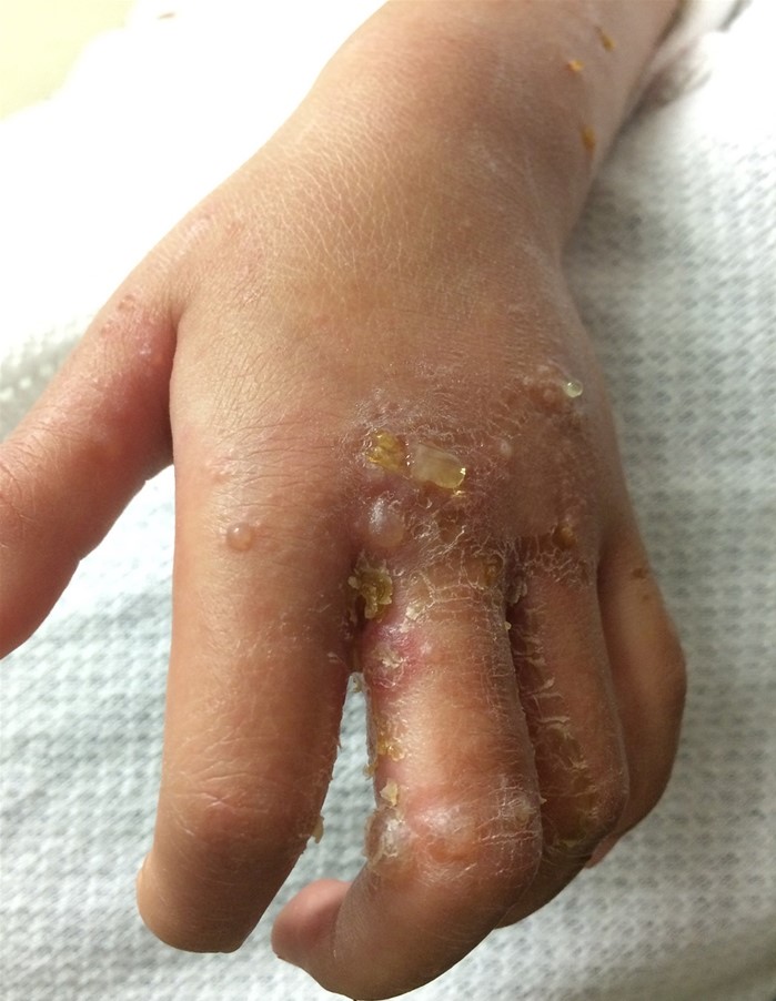 A 4-year-old girl is brought to the emergency department due to blisters on her left hand.  Two days ago, the patient developed small, fluid-filled lesions, which have since increased in size and are now mildly tender and itchy.  She has a history of eczema and takes no medications.  Temperature is 38.1 C (100.6 F) .  Vital signs are otherwise normal.  Examination findings of the hand are shown in the image below.  Which of the following is the most likely pathogen of this patient's condition?   A) Coxsackie virus B) Herpes simplex virus C) Sporothrix schenckii D) Staphylococcus aureus E) Streptococcus pyogenes F) Varicella zoster virus