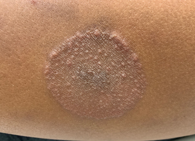 A 17-year-old girl is brought to the office due to a worsening rash on her left upper arm.  The rash was the size of a dime when the patient initially noticed it 3 weeks ago, but it has since grown in size, developed a raised edge, and become increasingly itchy.  She has applied moisturizing creams without improvement.  The patient takes no medications and has no allergies.  The rash is shown in the image below:   What is the most likely diagnosis for this patient? A) Dermatophyte infection B) Erythema migrans C) Psoriasis D) Subacute cutaneous lupus E) Urticaria