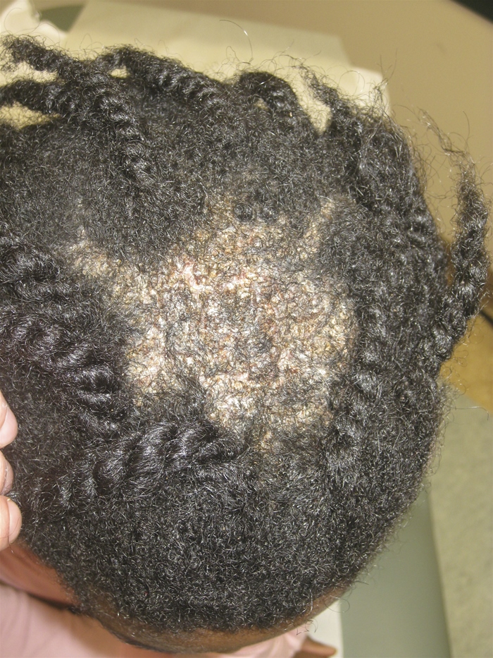 An 8-year-old previously healthy girl is brought to the office by her mother due to hair loss on the scalp.  Several weeks ago, the mother noticed the patch of hair loss, which has progressively enlarged.  The mother also says that the girl frequently scratches at the area.  The child recently changed to a different school and has been anxious about new teachers and friends.  Skin examination findings are shown in the image below.   There are several enlarged, tender, occipital and posterior auricular lymph nodes.  Which of the following is the most likely cause of this patient's condition? A) Autoimmune disorder B) Cutaneous candidiasis C) Dermatophyte infection D) Pressure-induced alopecia E) Repeated hair plucking F) Seborrheic dermatitis