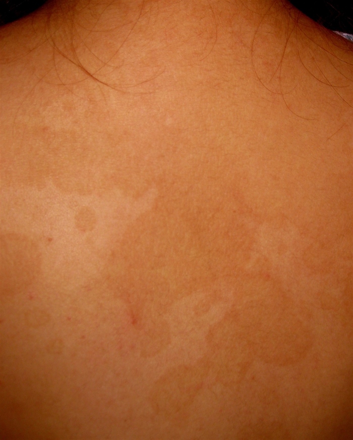 A 9-year-old girl is evaluated because of a rash.  Multiple light patches appeared on the patient's face, chest, back, and arms a week after she began attending a swim camp and became more pronounced over the past month.  The spots are mildly itchy but not painful.  No dietary changes or use of new soaps has occurred.  The patient applies a new suntan lotion 5 days a week while swimming in the camp's chlorinated pool; however, the spots do not tan even though the surrounding skin does.  She has a history of allergic rhinitis and takes oral antihistamines.  She has no history of major illness or hospitalization.  Vital signs are normal.  On examination, the patient is awake, alert, and comfortable.  There is mild nasal congestion with enlarged turbinates and clear postnasal drip but no pharyngeal erythema.  Lung sounds are clear.  No heart murmurs are present.  Multiple pale macules appear on the face, trunk, back, and upper arms, as shown in the image below.   Some of the spots have slight scaling, and they are not tender to palpation.  Which of the following is the most likely diagnosis in this patient? A) Atopic dermatitis B) Irritant contact dermatitis C) Mycosis fungoides D) Pityriasis rosea E) Seborrheic dermatitis F) Tinea versicolor G) Vitiligo