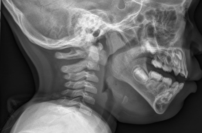 A 3-year-old boy is brought to the emergency department due to a sore throat.  The boy woke up with the sore throat this morning and has refused to eat.  His mother gave him acetaminophen, but it did not relieve his pain.  Temperature is 38.7 C (101.7 F)  and respirations are 28/min.  The patient is sitting still on his mother's lap and appears scared.  He has a hoarse voice, rhinorrhea, and mild stridor.  Tympanic membranes are clear bilaterally.  Examination of the posterior pharynx shows no erythema or tonsillar exudate.  The anterior neck is tender to palpation.  Lung examination reveals transmitted upper airway sounds that are equal bilaterally without crackles or wheezes.  Lateral neck x-ray is shown below:   Which of the following is the most likely diagnosis in this patient? A) Bacterial tracheitis B) Croup C) Epiglottitis D) Foreign body aspiration E) Peritonsillar abscess F) Retropharyngeal abscess