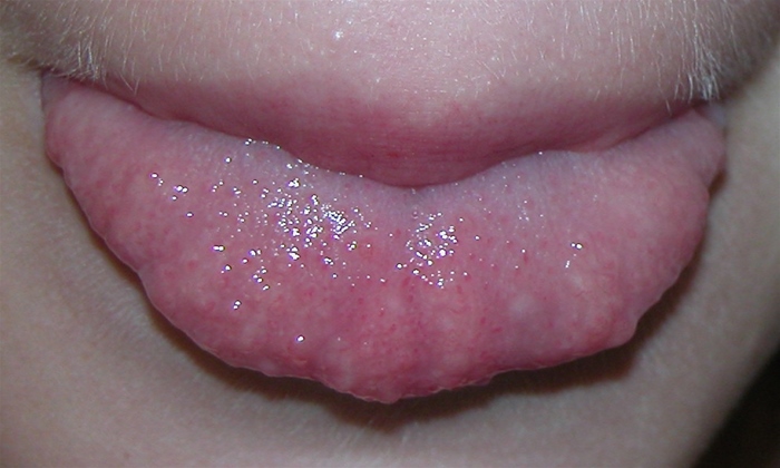 A 9-year-old boy is brought to the office for evaluation of oral lesions.  He had been living in a children's home until he was adopted 3 months ago.  He believes the tongue nodules have always been present.  They do not hurt or itch.  He has no taste disturbance and eats a variety of solids and liquids.  He is not bothered by drinking hot or cold liquids.  Vital signs are stable.  He is tall for his age with long arms and fingers.  Tongue examination is shown below.  On palpation, the tongue nodules feel discrete, firm, and rubbery.  They are not tender.  This patient is at greatest risk from which of the following conditions?   A) Arteriovenous malformation B) Colon polyps C) Pituitary tumor D) Refractory seizures E) Thyroid cancer