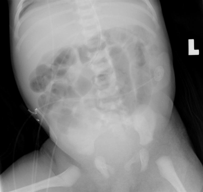 A 2-day-old girl in the newborn nursery is being evaluated for abdominal distension.  The patient was born at 39 weeks gestation to a 38-year-old woman by spontaneous vaginal delivery.  The mother received epidural analgesia with fentanyl for labor contractions, and the delivery was uncomplicated.  Since birth, the girl has shown little interest in breast or bottle feeding.  She spit up the last feed but has not vomited.  The patient has not yet passed meconium.  On physical examination, the anterior fontanelle is open and flat.  The palate is intact, and the neck is supple.  Cardiopulmonary examination is unremarkable.  The abdomen is firm and distended.  Examination of the back shows a shallow, 2-mm diameter sacral dimple, and the overlying skin is intact without rashes or hair.  Digital rectal examination reveals increased tone followed by release of stool.  Extremities appear normal with equal strength and reflexes bilaterally.  Abdominal x-ray is shown in the image below:   Which of the following is the most likely mechanism for this patient's findings? A) Failure of neural crest cell migration during fetal development B) Incomplete bowel rotation during embryogenesis C) Intestinal ileus from exposure to maternal epidural analgesia D) Intestinal obstruction from inspissated meconium E) Spinal cord dysfunction due to abnormal neural tube closure