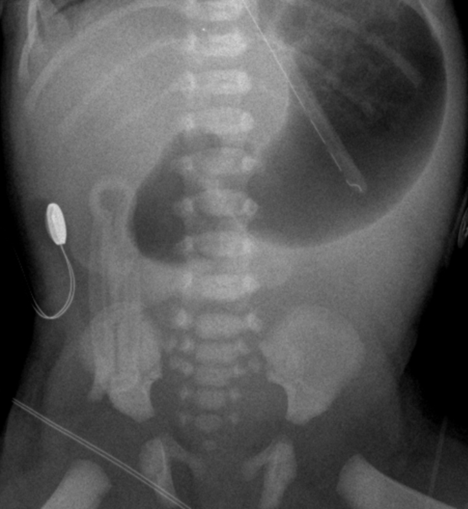 A 10-hour-old boy in the newborn nursery has bilious emesis.  He was born at 38 weeks gestation by vaginal delivery to a primigravid 39-year-old woman who received no prenatal care.  The patient has voided once but has not yet passed meconium.  Physical examination shows a hypotonic neonate with a flat face, prominent tongue, low-set ears, and slanted palpebral fissures.  The hands are short with incurved fifth fingers, and a large space is present between bilateral first and second toes.  The abdomen is soft and without distension, guarding, or rigidity.  Auscultation reveals a loud holosystolic murmur most prominent at the left lower sternal border with a precordial thrill.  A nasogastric tube is placed, and abdominal x-ray is shown below.   In addition to echocardiogram, which of the following is the best next step in this patient? A) Barium enema B) Karyotype C) Pyloric ultrasound D) Rectal biopsy E) Surgical repair F) Sweat test G) Upper gastrointestinal series
