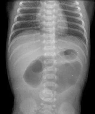 A 12-hour-old girl in the neonatal intensive care unit has bilious emesis.  She was born at 35 weeks gestation by vaginal delivery to a 22-year-old woman who did not receive prenatal care and used cocaine during her pregnancy.  The infant has urinated but has not had a bowel movement.  She was able to take 2 bottle feeds by mouth but has been vomiting green fluid since the third feed.  Birth weight was 2 kg (4 lb 6 oz) , which is small for gestational age.  Temperature is 36.9 C (98.4 F) , pulse is 160/min, and respirations are 40/min.  The abdomen is distended.  The rest of the examination is unremarkable.  Abdominal x-ray is shown below.   Which of the following is the most likely diagnosis in this patient? A) Cocaine withdrawal B) Duodenal atresia C) Hirschsprung disease D) Jejunal atresia E) Necrotizing enterocolitis F) Pyloric stenosis