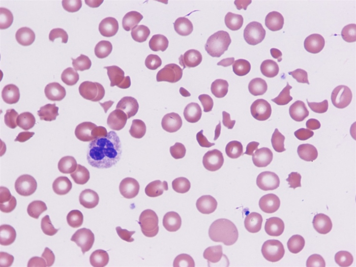 A 3-year-old boy is brought to the clinic by his father due to fatigue and pallor.  The patient was seen in another clinic a week ago for abdominal pain and diarrhea.  A medication was prescribed to help slow the diarrhea, which resolved, but the patient has been much less playful over the last day.  Temperature is 36.7 C (98 F) , blood pressure is 110/70 mm Hg, pulse is 120/min, and respirations are 20/min.  Physical examination shows an uncomfortable-appearing child with scleral icterus.  Cardiac examination shows mild tachycardia with no murmurs.  A few ecchymoses are noted along the upper and lower extremities.  There is pitting edema along bilateral lower extremities to the knees.  The remainder of the examination is unremarkable.  Laboratory results are as follows:   Peripheral blood smear results are shown in the image below:   Which of the following is the most likely mechanism of this patient's condition? A) Antibody-mediated destruction of red blood cells B) Decreased erythropoietin production C) Defective globin chain synthesis D) Deficiency in an enzyme that protects cells from oxidative injury E) Intravascular shearing of red blood cells F) Systemic activation of coagulation system