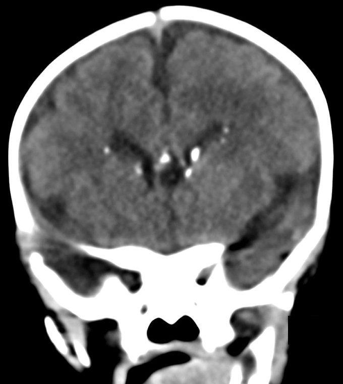 A 1-day-old boy is admitted to the neonatal intensive care unit due to microcephaly.  Microcephaly and ventriculomegaly were first seen during an antenatal sonogram at 20 weeks gestation.  Follow-up ultrasounds revealed progressive fetal growth restriction for which a cesarean delivery was performed at 35 weeks gestation.  The mother is a 28-year-old woman, gravida 3 para 3, who is healthy and took prenatal vitamins.  The infant's 2 siblings, age 18 months and 4 years, are healthy.  Weight and length are at the 5th percentile, and head circumference is <3rd percentile.  Temperature is 37.2 C (99 F) , and the remaining vital signs are normal.  Physical examination shows a jaundiced infant who is small for gestational age.  The lungs are clear to auscultation, and no murmurs are audible.  The liver edge is palpable at the level of the umbilicus.  Platelet count is 25,000/mm<sup>3</sup>.  CT scan of the head is shown below.   The most likely source of congenital infection is maternal exposure to which of the following? A) Cat feces B) Genital lesion C) Mosquitoes D) Raw meat E) Saliva