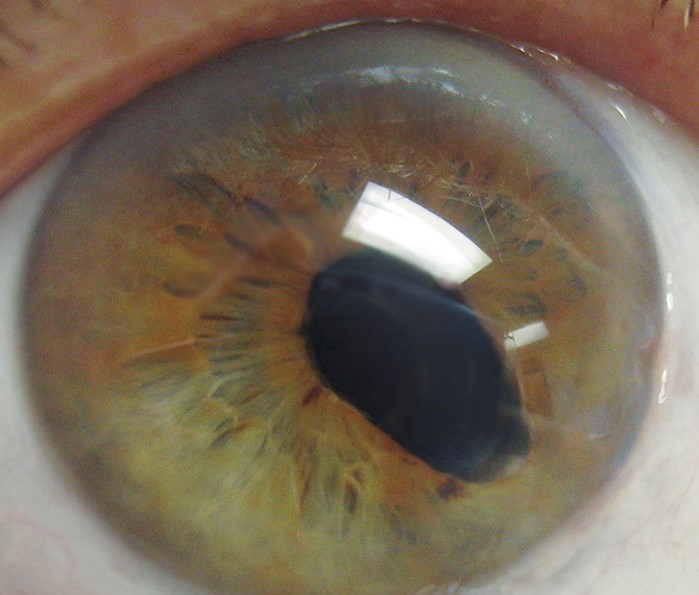 A newborn boy is being evaluated in the nursery for respiratory distress.  He was born an hour ago at 37 weeks gestation via spontaneous vaginal delivery to a primigravid mother who had scant prenatal care.  Delivery was uneventful.  During skin-to-skin contact, the mother noticed his face turn blue.  The patient was stimulated and began crying, which improved his color.  Weight, length, and head circumference are in the 25th-50th percentile.  Temperature is 36.8 C (98.2 F) , pulse is 150/min, and respirations are 48/min.  Pulse oximetry is 97% on room air.  As the crying stops, pulse oximetry decreases to 80% on room air.  A 5-French catheter is unable to be passed through either naris.  The ears are short and wide with no earlobes.  The right eye is as shown below:   Oropharyngeal examination reveals a cleft palate.  The patient has a loud, harsh, holosystolic murmur best heard at the lower left sternal border.  The testes are not palpable.  The skin and extremities appear normal.  Which of the following is the most likely diagnosis in this patient? A) CHARGE syndrome B) DiGeorge syndrome C) Fanconi anemia D) Trisomy 13 E) VACTERL syndrome