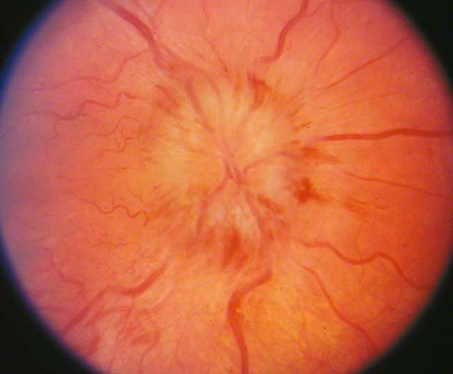 An 11-year-old girl is brought to the clinic due to blurry vision.  The symptoms began 2 weeks ago at school, when a teacher noticed that the child often moved closer to the front of the classroom to see the board.  At home, the patient takes frequent breaks when playing video games because of nausea and headaches.  She has type 1 diabetes mellitus, which was diagnosed 2 years ago after she was hospitalized for diabetic ketoacidosis.  Since then, the diabetes has been well controlled with insulin.  The patient's vision examination 6 months ago was normal.  Visual acuity today shows 20/40 bilaterally with no changes after refraction.  The pupils are equal and reactive to light, and extraocular movements are intact.  Visual fields are full, with enlarged blind spots bilaterally.  Dilated retinal examination is shown in the image below:   The remainder of the neurologic examination is normal.  Which of the following is the most likely cause of this patient's symptoms? A) Diabetic retinopathy B) Idiopathic intracranial hypertension C) Pituitary adenoma D) Retinitis pigmentosa E) Retinoblastoma