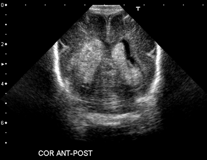 A 2-day-old girl develops seizures and a bulging anterior fontanelle.  Temperature is 36.8 C (98.2 F) , pulse is 180/min, and capillary refill is >4 seconds.  Cardiac examination reveals tachycardia.  Neurologic examination shows rhythmic contractions of the upper extremities, tongue thrusting, and lip smacking.  Head ultrasound is shown below:   Which of the following conditions most likely led to this patient's condition? A) Arteriovenous malformation B) Berry aneurysm C) Congenital infection D) Placental abruption E) Prematurity