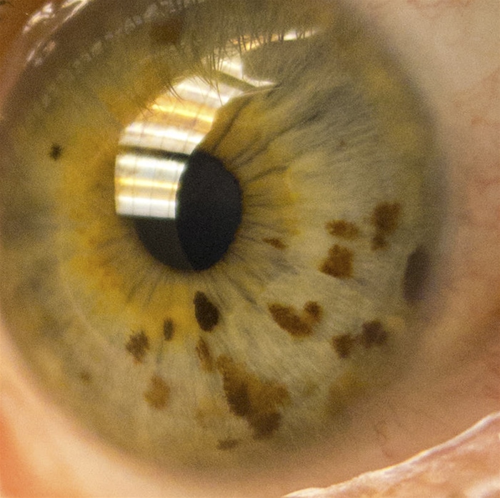 A 13-year-old girl comes to the office for a routine well-child visit.  She reports skin lesions on her trunk that are not painful or pruritic but have increased in size and number over the past few years.  She has no chronic medical problems and takes no medications.  Vital signs are within normal limits.  Physical examination reveals several large, uniformly pigmented, macular skin lesions.  Her eye examination is shown below.   This patient is at greatest risk of developing which of the following? A) Acute hepatic failure B) Acute lymphoblastic leukemia C) Nerve sheath tumors D) Renal angiomyolipoma E) Retinal hemangioblastoma