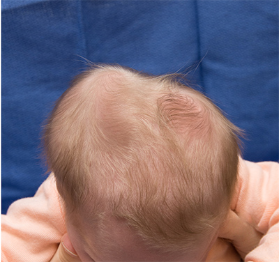 A 1-day-old girl is being evaluated in the newborn nursery.  She was born at 39 weeks gestation.  Vital signs are normal.  Examination shows a vigorous newborn with a firm, nonfluctuant swelling confined to the right side of the skull, as seen in the image below:   In addition to monitoring bilirubin levels, which of the following is the best next step in management of this patient? A) Brain MRI B) Cranial molding helmet C) Hematoma evacuation D) Reassurance and observation only E) Serial hemoglobin levels