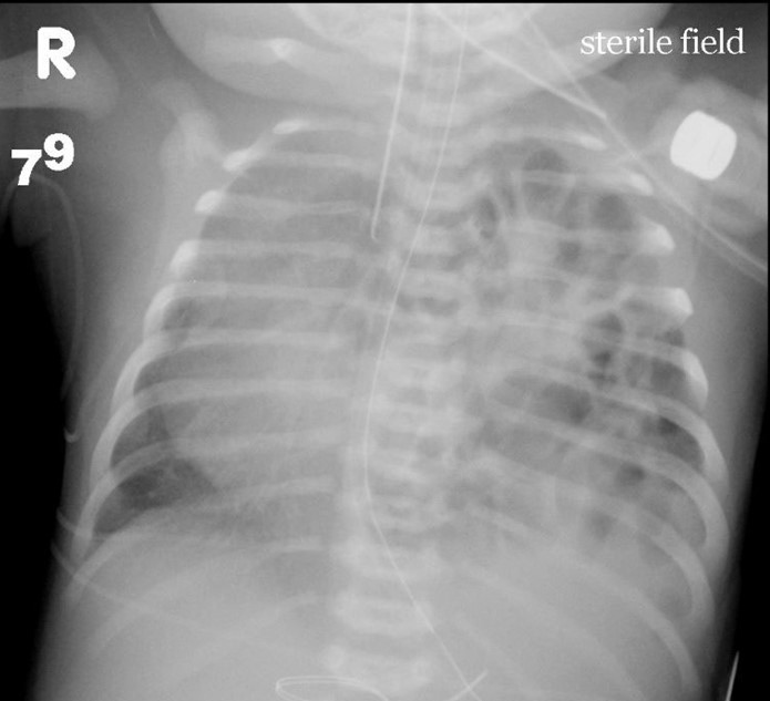 A newborn boy is evaluated in the delivery room 10 minutes after birth for increasing respiratory distress.  He was born at 38 weeks gestation by a forceps-assisted vaginal delivery complicated by a 2-minute shoulder dystocia.  The infant's mother did not receive any prenatal care.  Temperature is 36.8 C (98.2 F) , blood pressure is 70/40 mm Hg, pulse is 168/min, and respirations are 72/min.  Oxygen saturation is 82% on room air.  Physical examination shows grunting, nasal flaring, and cyanosis of the mucous membranes.  Chest x-ray is shown below:   Which of the following is the most likely diagnosis in this patient? A) Congenital diaphragmatic hernia B) Group B Streptococcus pneumonia C) Tension pneumothorax D) Tetralogy of Fallot E) Transient tachypnea of the newborn