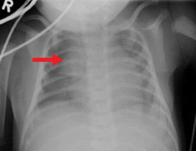 A 5-month-old full-term boy is brought to the physician for fever.  He was doing well until this morning, when he felt warm to his mother.  He has had a  runny nose  and intermittent coughing but otherwise has been breastfeeding well.  His 3-year-old brother had an upper respiratory tract infection last week.  The infant takes vitamin D, and his vaccinations are up to date.  His temperature is 38. 9 C (102 F) , blood pressure is 90/60 mm Hg, pulse is 120/min, and respirations are 32/min.  Pulse oximetry shows an oxygen saturation of 96%.  Examination shows crusted rhinorrhea at the nares.  The patient's chest radiograph is shown below.   Which of the following is marked on this patient's chest radiograph? A) Hilar lymphadenopathy B) Right atrium C) Right middle-lobe infiltrate D) Right upper-lobe atelectasis E) Right upper-lobe infiltrate F) Thymus