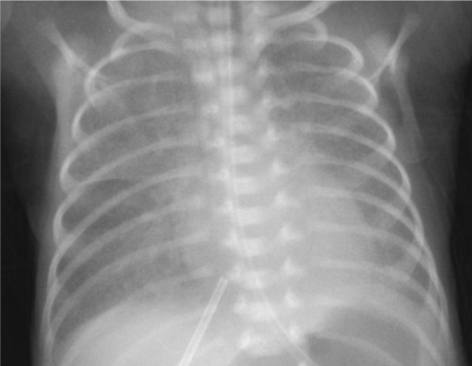 A 10-minute-old neonate is evaluated in the delivery room for low oxygen saturation and difficulty breathing.  The patient was born at 36 weeks gestation to a 37-year-old mother whose pregnancy was complicated by poorly controlled type 2 diabetes mellitus.  Membranes were ruptured 3 hours prior to delivery, and the fluid was clear.  Apgar scores were 5 and 7 at 1 and 5 minutes, respectively.  Temperature is 36.9 C (98.4 F) , pulse is 166/min, and respirations are 70/min.  Examination shows cyanosis of the lips and mucous membranes.  The patient is grunting and has intercostal and subcostal retractions.  Cardiac examination shows a 1/6 systolic ejection murmur at the left upper sternal border.  Breath sounds are decreased bilaterally.  The abdomen is soft with no organomegaly.  Pulses are 2+ in all extremities.  Pulse oximetry on room air is 64% in the right hand and foot.  An orogastric tube is placed, and the patient is started on continuous positive airway pressure with supplemental oxygen.  Pulse oximetry improves to 82%.  Chest radiograph is shown in the image below:   Blood cultures are obtained, and intravenous antibiotics are started.  Which of the following is the most appropriate pharmacotherapy for this patient? A) Corticosteroids B) Indomethacin C) Nitric oxide D) Prostaglandin E) Surfactant