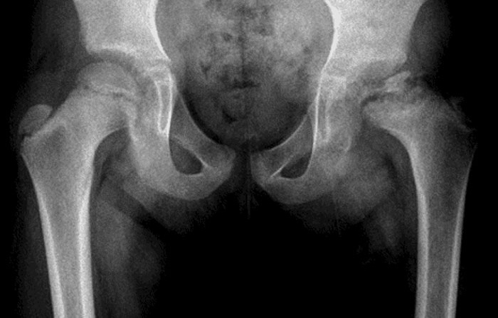 A 7-year-old boy is brought to the office for evaluation of chronic left thigh pain and a limp.  The pain began 8 months ago as an intermittent ache, especially after soccer practice.  The patient's family thought his symptoms were growing pains and have been giving him ibuprofen as needed for pain, with some improvement.  Over the past month, however, the pain has been constant, and the patient recently developed a limp.  He has had no fever, additional joint pain, or chronic medical problems and takes no daily medications.  While walking to the examination table, the patient avoids bearing full weight on the left leg.  Examination shows significantly limited range of motion of the left hip and atrophy of the left proximal thigh muscle.  The remainder of the examination is unremarkable.  X-ray of the pelvis is shown in the image.   Which of the following is most likely responsible for this patient's condition? A) Bone infection B) Malignancy C) Muscular dystrophy D) Osteonecrosis E) Slipped epiphysis F) Stress fracture G) Synovitis