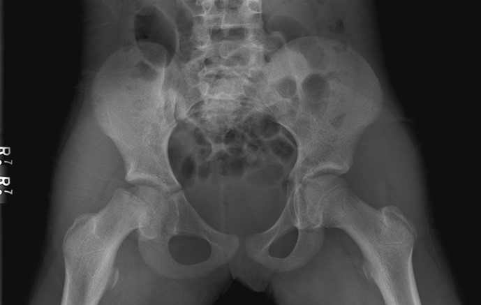 A 10-year-old girl is brought to the clinic for evaluation of a limp.  She first noticed mild pain in the right groin 2 weeks ago and took ibuprofen, which initially helped.  The pain acutely worsened 2 days ago after the patient fell while ice skating.  Since then, she has been unable to fully bear weight on her right leg due to pain, which is now minimally relieved with ibuprofen and rest.  The patient has autoimmune hypothyroidism for which she takes levothyroxine.  Temperature is 37.2 C (99 F) .  Height and weight are at the 10th and 25th percentiles for age, respectively.  When the right hip is flexed, there is external rotation of the hip.  When the left hip is flexed, the hip remains in a neutral position.  There is normal range of motion in both knees and no redness or edema overlying the hips and knees.  The patient has a limp and bears little weight on her right side when walking.  Bilateral hip radiograph with frog-leg lateral view reveals the following:   Which of the following is the best next step in management of this patient? A) Closed reduction of the hip joint B) Oral methotrexate therapy C) Physis stabilization with screw fixation D) Rest and analgesics as needed E) Total joint replacement