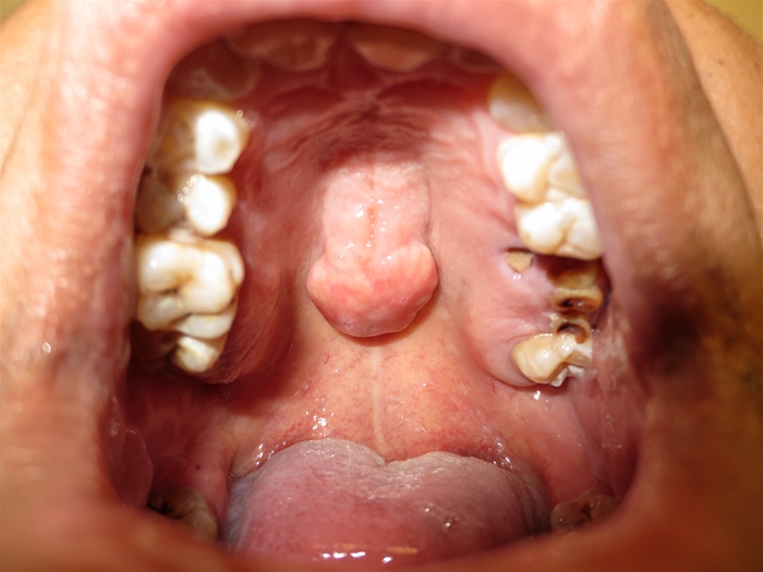 A 25-year-old man comes to the office for evaluation of a painless mass in his mouth.  The patient has had the mass for many years and has had no growth or other changes in the mass over that time.  He has had occasional sinus infections and was in a motor vehicle accident several years ago in which he sustained a concussion, but he is otherwise healthy.  The patient smokes a pack of cigarettes a day and drinks 2 or 3 alcoholic beverages on the weekends.  Vital signs are normal.  Examination of the mass is seen below:   The mass is immobile, nontender, and has a hard consistency.  The maxillary and frontal sinuses are nontender, and there is no cervical lymphadenopathy.  Which of the following is the most likely cause of this patient's mass? A) Congenital anomaly B) Infectious sequelae C) Malignant transformation D) Palatal fracture E) Vascular malformation