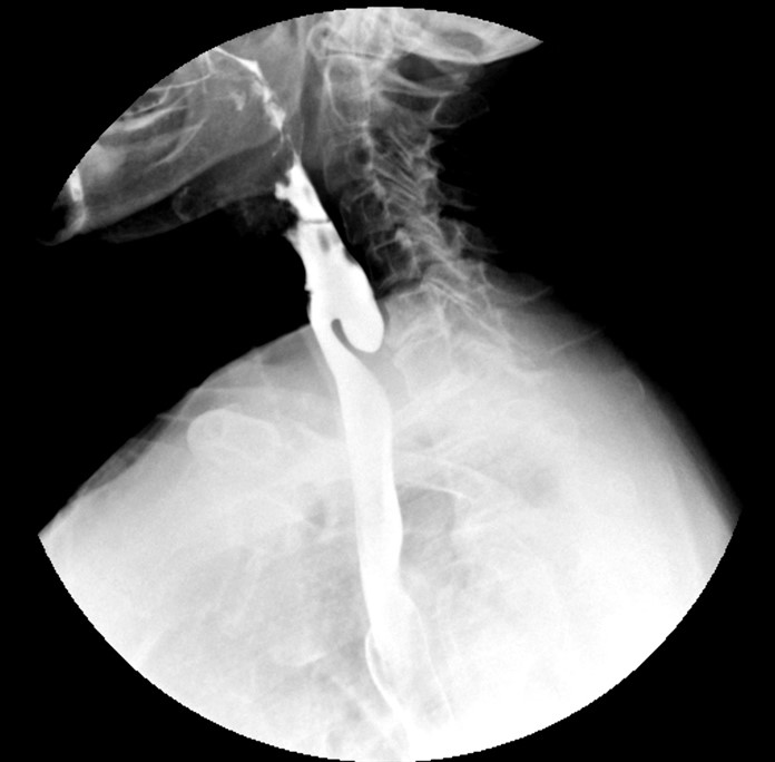 A 68-year-old woman comes to the office due to food getting  stuck  in her throat, which has worsened over the past 2 years.  She occasionally has to get out of bed to vomit, although she does not vomit during the day.  She has not changed her diet or lost weight.  Medical history includes obesity, hypertension, and diabetes.  A barium esophagogram is shown in the image below.  Which of the following is the most appropriate next step in management of this patient?   A) Cricopharyngeal myotomy B) Esophageal balloon dilation C) Ligamentum arteriosum ligation D) Oral metoclopramide E) Oral omeprazole F) Swallowing rehabilitation