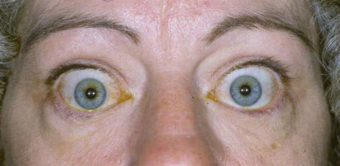 A 56-year-old woman comes to the office due to eye irritation, painful eye movements, and diplopia.  Over the last few weeks, she has also experienced weight loss and fatigue.  The patient smokes a pack of cigarettes a day and has a 25-pack-year history.  Other medical problems include chronic obstructive pulmonary disease treated with an inhaled corticosteroid and bronchodilators.  She also suffered a head injury in a motor vehicle accident 6 months ago.  Blood pressure is 146/70 mm Hg, pulse is 110/min, and respirations are 18/min.  On physical examination, the patient is unable to maintain eye convergence and experiences diplopia on upward gaze.  Her eyes are shown in the image below.   Which of the following is the most likely cause of this patient's examination findings? A) Brain stem injury B) Increased intracranial pressure C) Increased intraocular pressure D) Neuromuscular junction disorder E) Orbital tissue expansion F) Paraneoplastic syndrome