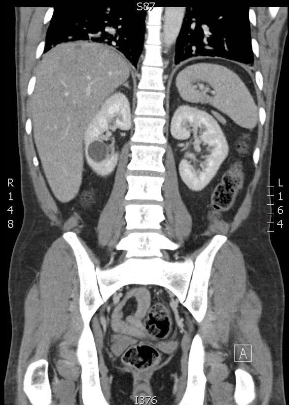 A 54-year-old man comes to the emergency department with cramping lower abdominal pain, mild nausea, and 2 episodes of watery diarrhea.  The patient has no fever, vomiting, or urinary symptoms.  His past medical history is unremarkable.  The patient's father died at age 60 from abdominal aortic aneurysm rupture.  He is a lifetime nonsmoker.  His vital signs are normal.  CT scan of the abdomen with contrast is shown in the image below:   All gastrointestinal symptoms resolve in 2 hours without any intervention, and the patient wants to go home.  Which of the following is the most appropriate management for the renal findings on the CT scan? A) Antibiotics B) Percutaneous aspiration C) Reassurance only D) Surgical excision E) Ureteral stent placement