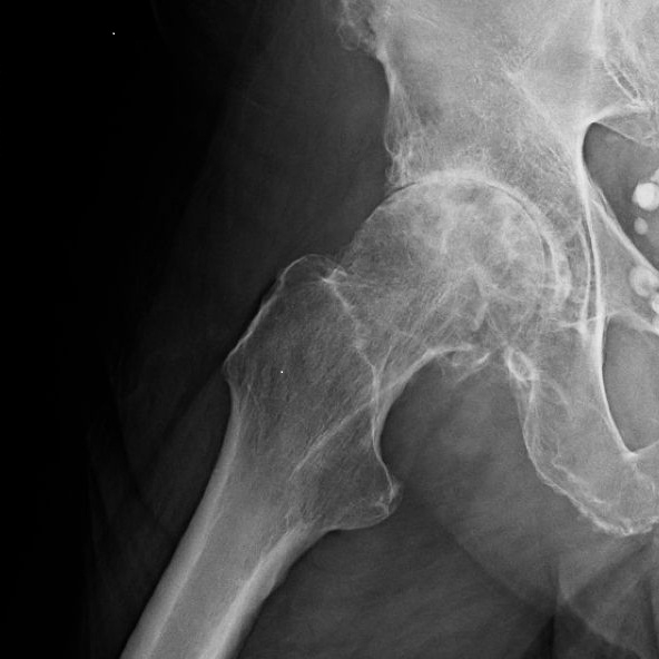 A 75-year-old man comes to the office for evaluation of right hip pain.  The patient first noticed the pain several months ago and it has become increasingly worse.  He now has trouble putting on his shoes and socks.  The patient used to walk his dog for 2 miles each night, but he now must use a cane and can only walk a half-mile.   The patient has a history of hypertension.  BMI is 32 kg/m<sup>2</sup>.  X-ray of the right hip is shown below:   Which of the following is the most likely cause of this patient's hip pain? A) Avascular necrosis B) Femur fracture C) Greater trochanteric pain syndrome D) Hip dislocation E) Osteoarthritis F) Osteosarcoma